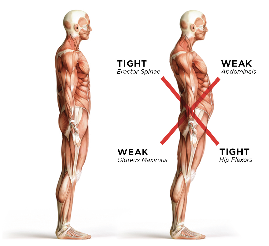 Weak back muscles online posture